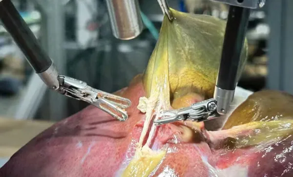 Robô com IA faz cirurgia inédita em humano e impressiona médicos